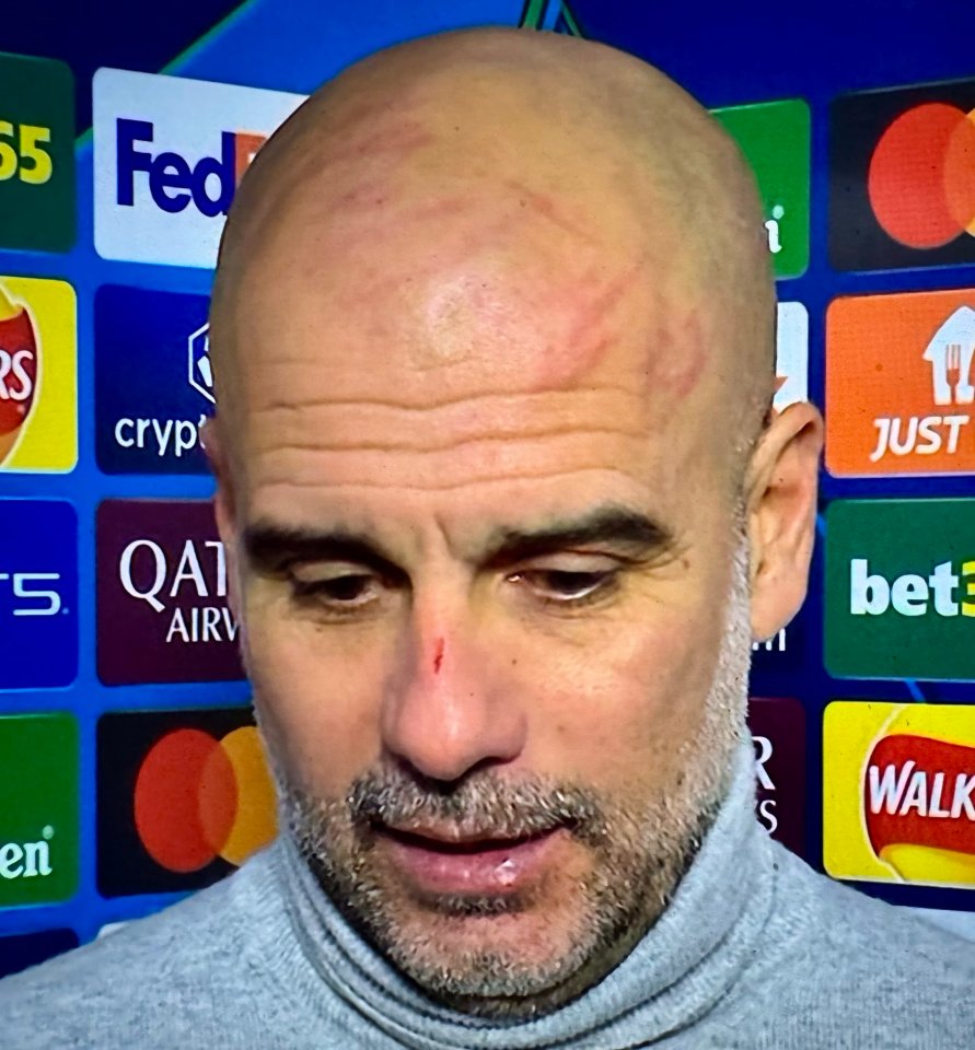 Pep Guardiola with scratches on his head and a bloody nose.