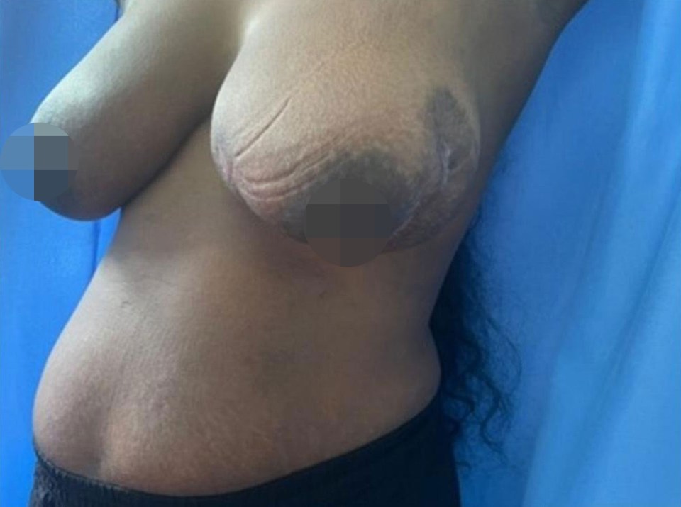 Three-month postpartum healed breast scarring after necrotizing fasciitis.