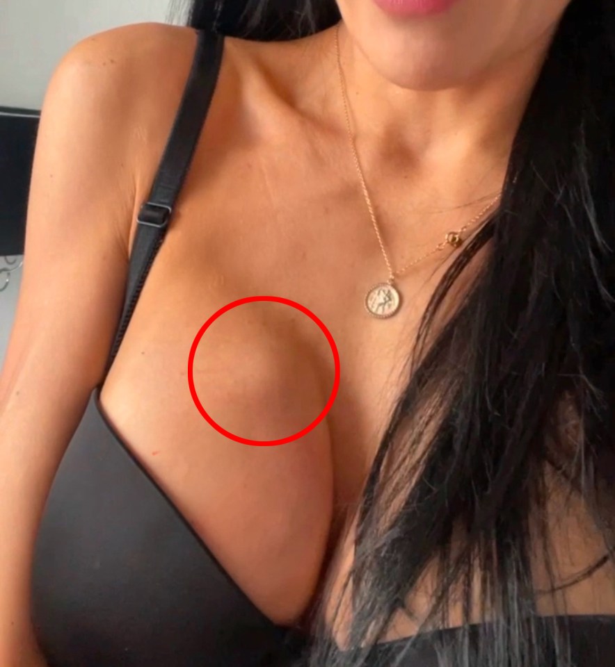 Close-up photo of a woman's breast showing a lump circled in red.