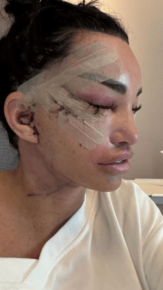 Close-up of a woman's face post-surgery, showing incisions and bandages.