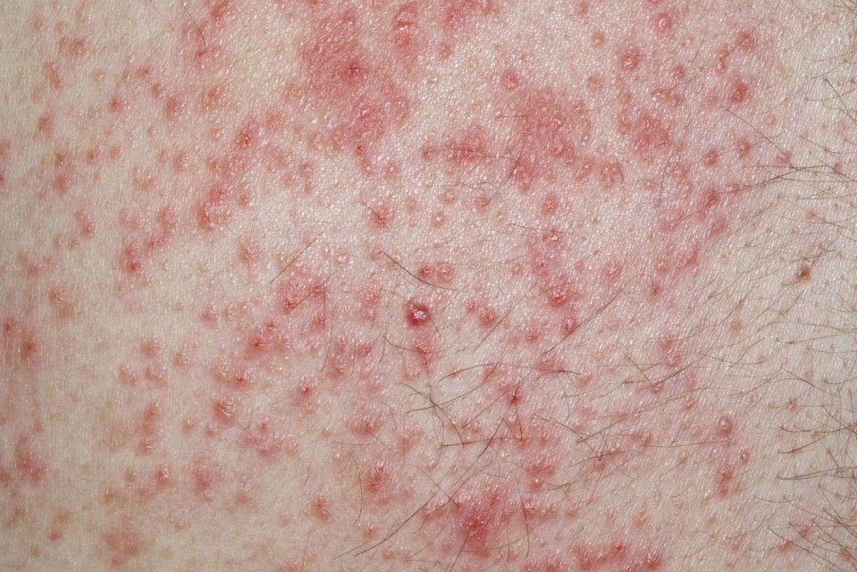 Close-up image of contact dermatitis.