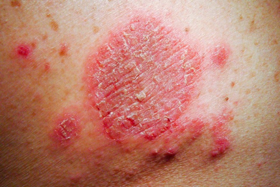 Close-up of discoid eczema on skin.