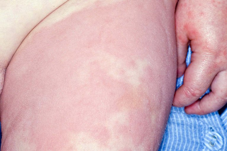 Hives rash on a person's thigh.