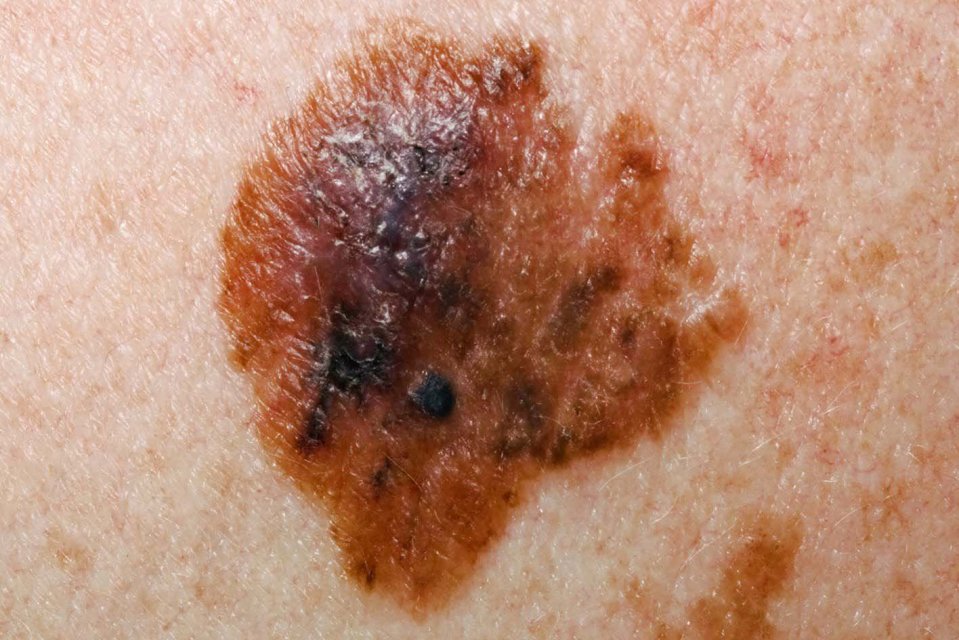 Close-up image of a melanoma.