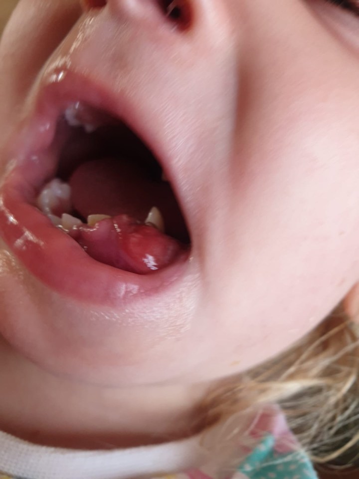 Close-up of a young girl's mouth showing a tumor.