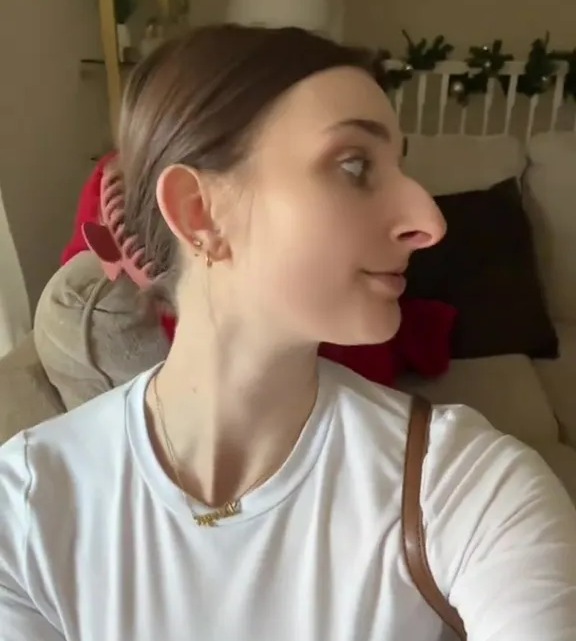 Woman showing her nose profile after rhinoplasty.