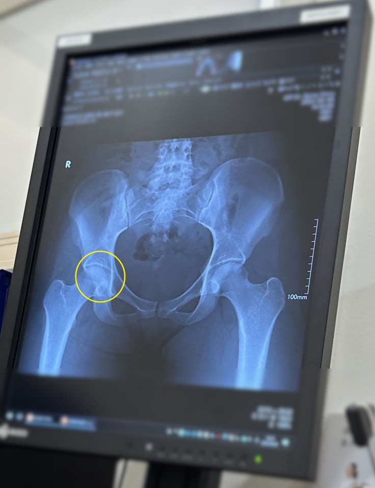 X-ray of a hip showing a stress fracture.