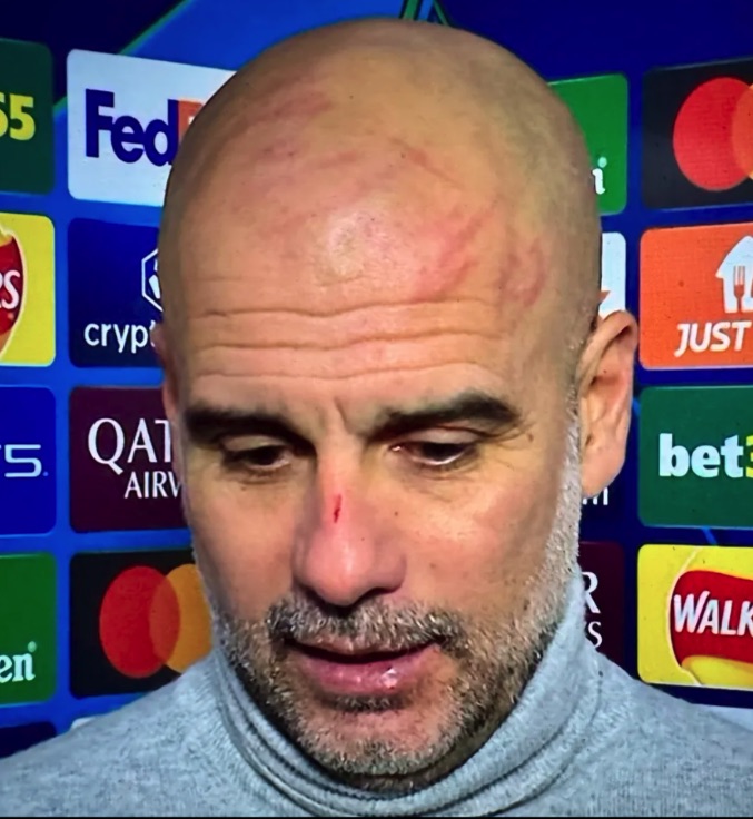 Close-up of Pep Guardiola with a cut on his nose and scratches on his forehead.