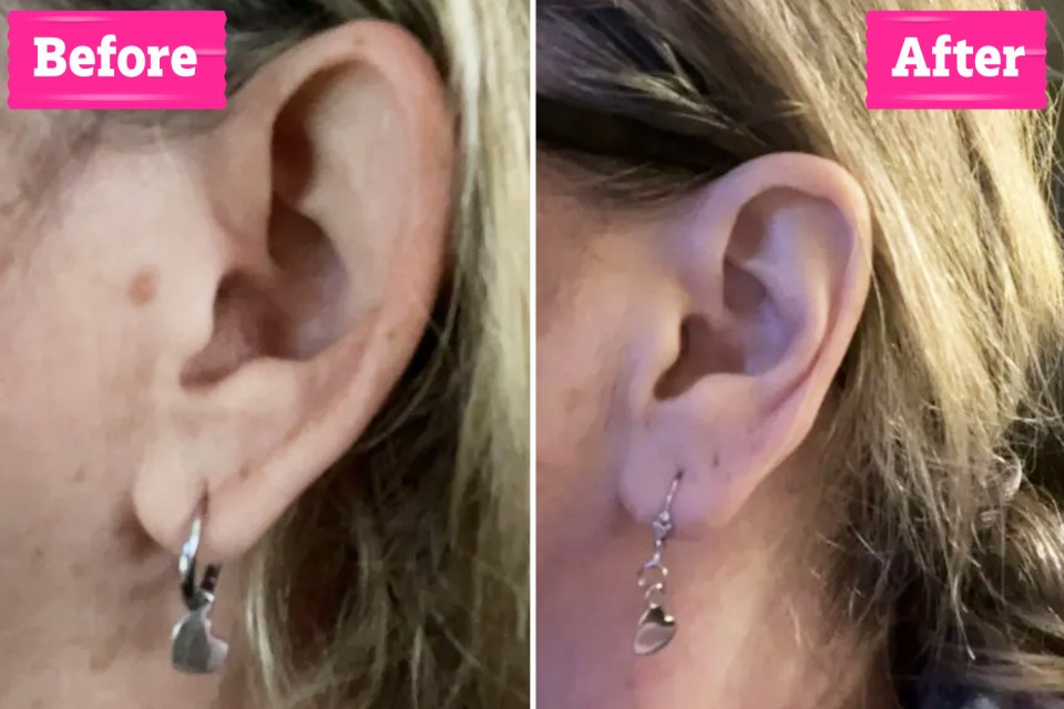 Before and after photos of an ear piercing.