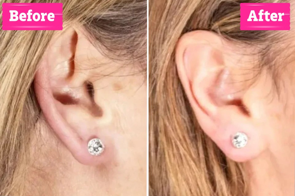 Before and after earlobe correction.