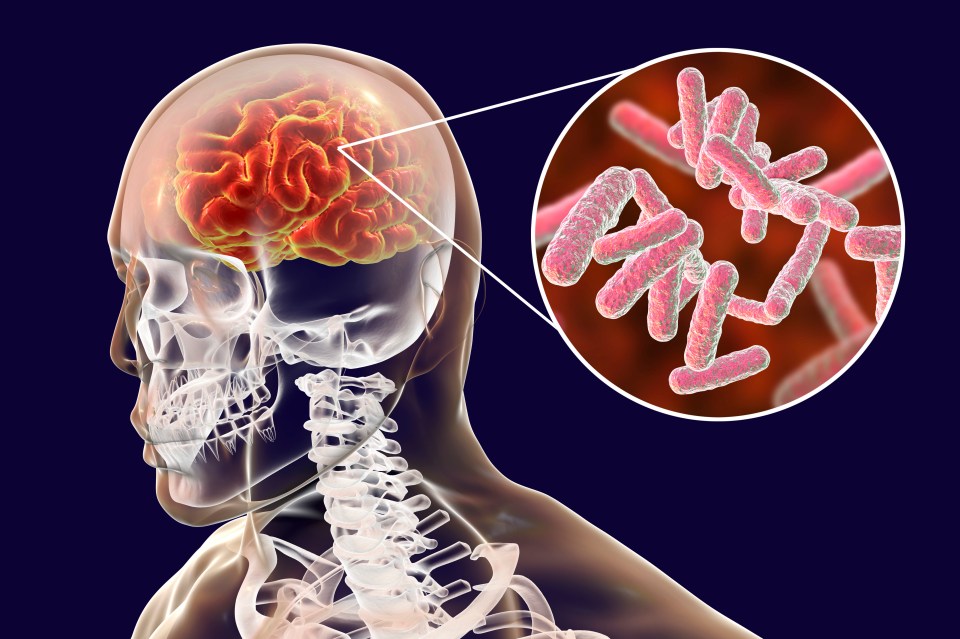 Illustration of bacterial encephalitis: a brain with inflammation and bacteria.