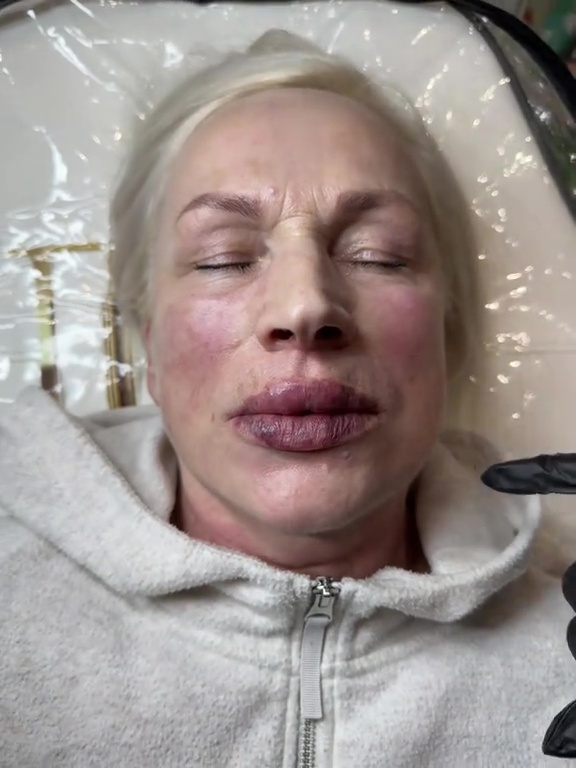 Close-up of a woman's face showing a severe reaction to lip filler.