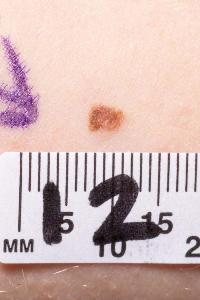 Close-up of a skin lesion with a millimeter ruler for scale.