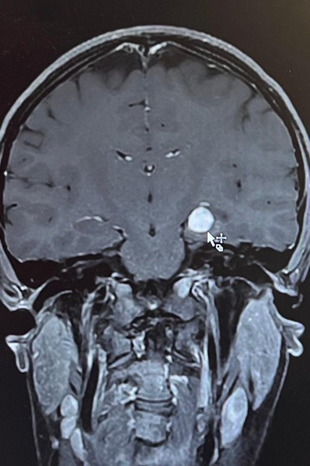 MRI scan showing a brain tumor.