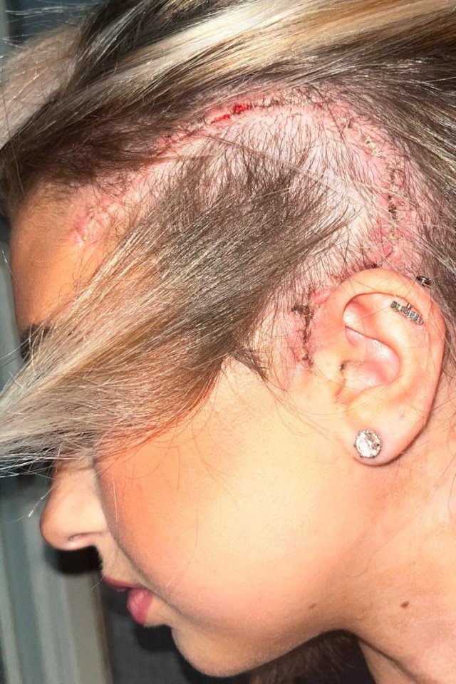 Scar on a young woman's head following brain tumour surgery.