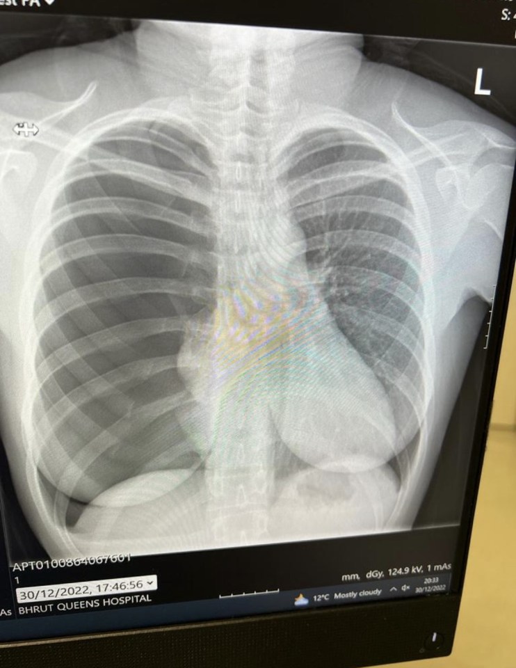 X-ray of a collapsed lung.