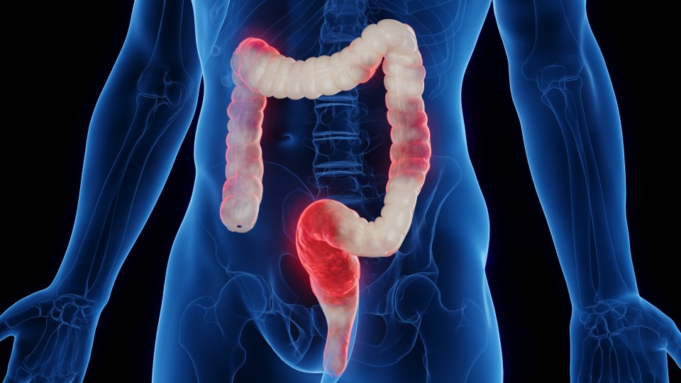 Illustration of an inflamed colon.