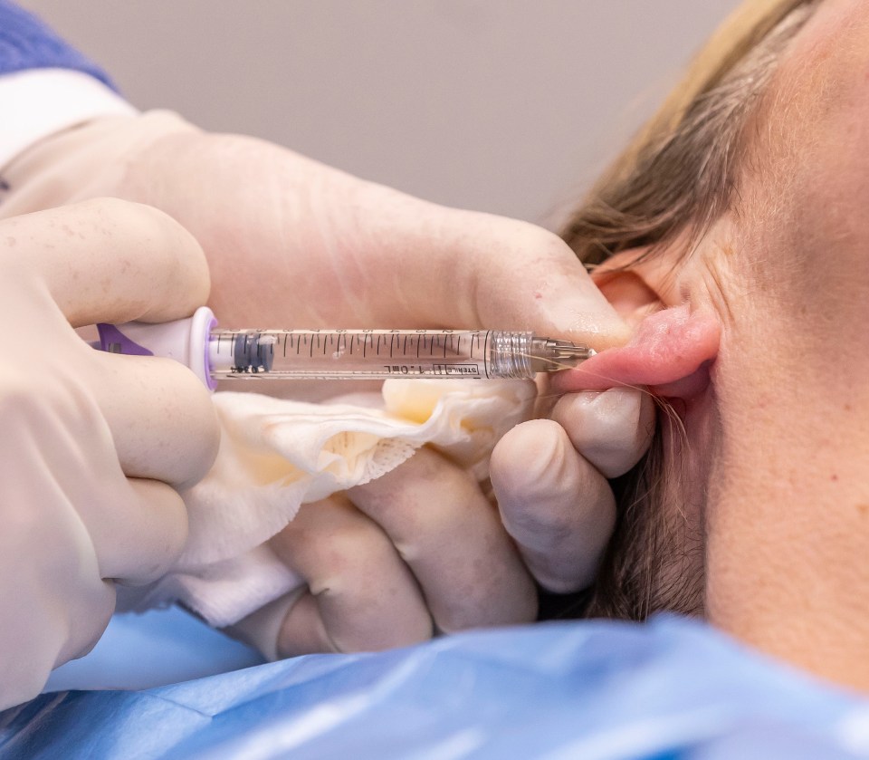 Close-up of earlobe filler injection.