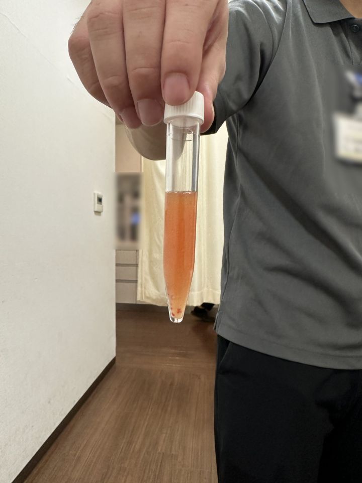 Test tube with orange synovial fluid containing blood particles.