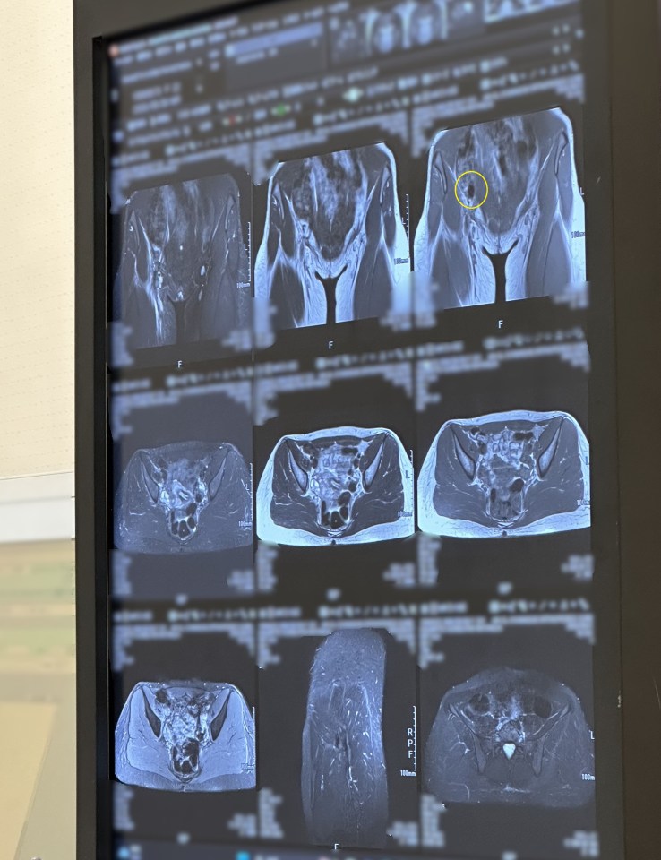 MRI scan of a hip showing fluid buildup.