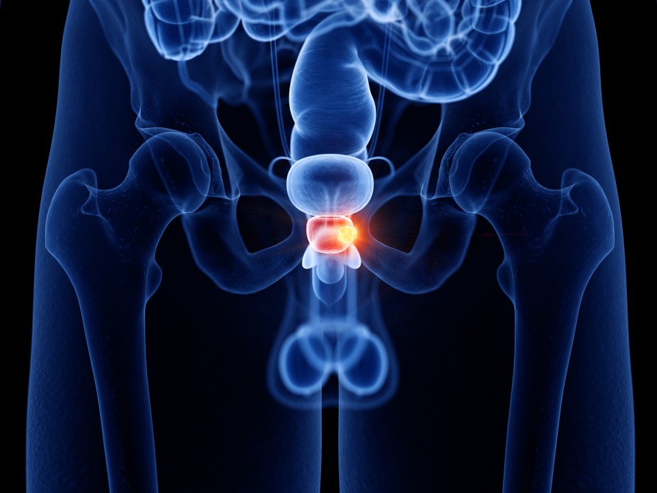 Illustration of prostate cancer.