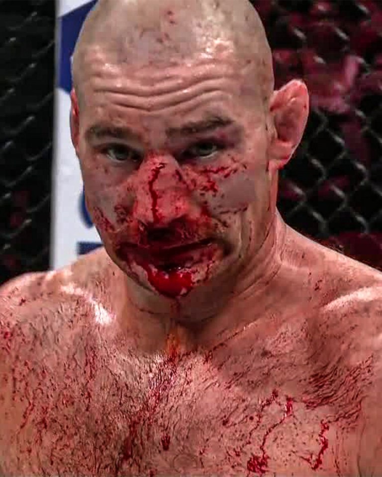 Sean Strickland, UFC fighter, heavily bleeding from facial injuries.